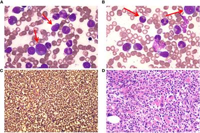 Case report: Safety and efficacy of synergistic treatment using selinexor and azacitidine in patients with atypical chronic myeloid leukemia with resistance to decitabine